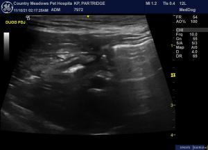 Pyloric – duodenal intussusception