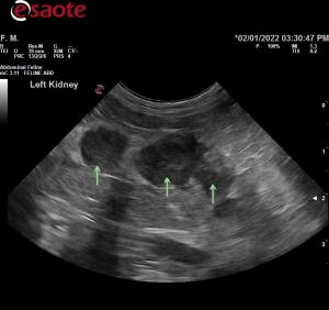 Hypoechoic nodules associated with left pancreatic limb