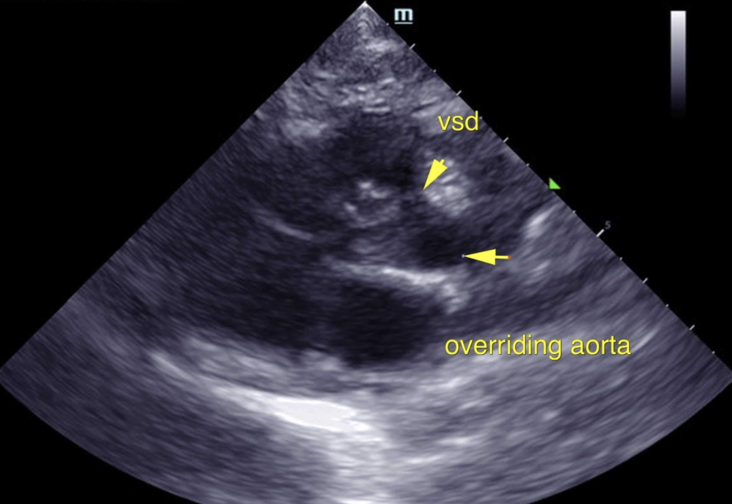 vsd_over_riding_aorta_screen_shot_2022-02-23_at_9