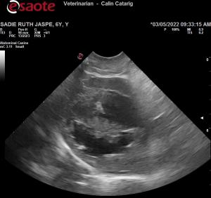 Ruptured Mucocele with Peritonitis