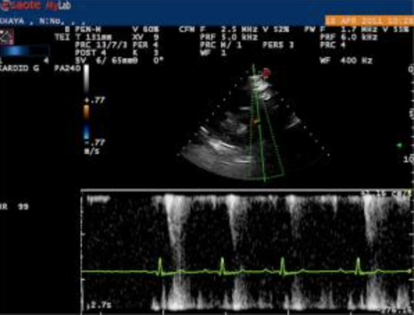 Subaortic Stenosis Sas Members